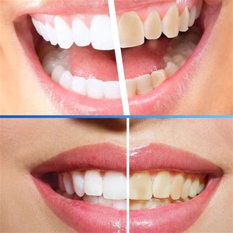 Magic natural teeth whitening